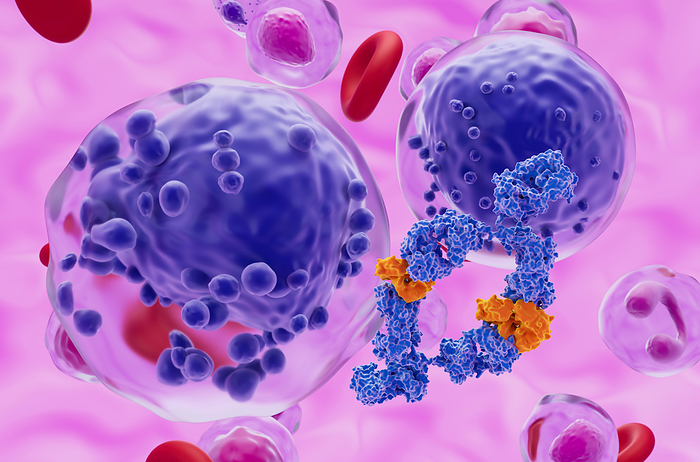 Monoclonal antibody treatment of acute myeloid leukaemia, illustration Illustration of a human monoclonal antibody drug  blue and orange  and acute myeloid leukaemia  AML  cells  purple . This cancer affects the myeloid tissue  bone marrow , specifically the white blood cell precursors  myeloblasts  that form a type of white blood cell known as granulocytes. These immature cells fill up the bone marrow and spill into the bloodstream and circulate throughout the body. The cells do not work properly to fight infections and their increased production reduces the production of red blood cells leading to anaemia and fatigue. Acute leukaemias progress quickly., by NEMES LASZLO SCIENCE PHOTO LIBRARY