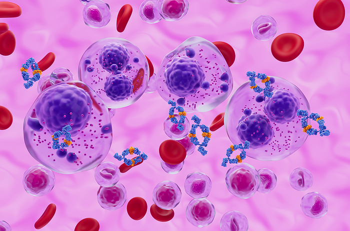 Monoclonal antibody treatment of multiple myeloma cell, illustration Illustration of a human monoclonal antibody drug  blue and orange  and multiple myeloma cells  purple . Multiple myeloma is type of cancer, it occurs when a plasma cell becomes abnormal and cancerous. The cancerous plasma cell divides and multiplies creating large amounts of abnormal antibodies., by NEMES LASZLO SCIENCE PHOTO LIBRARY
