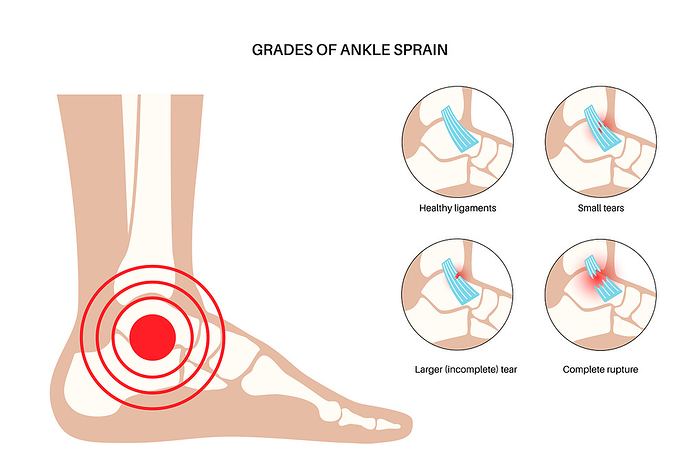 Ankle sprain injury, illustration Ankle sprain grades, illustration. Twisted feet, pain and swelling. Tearing, stretching or rupturing of ligaments., by PIKOVIT   SCIENCE PHOTO LIBRARY