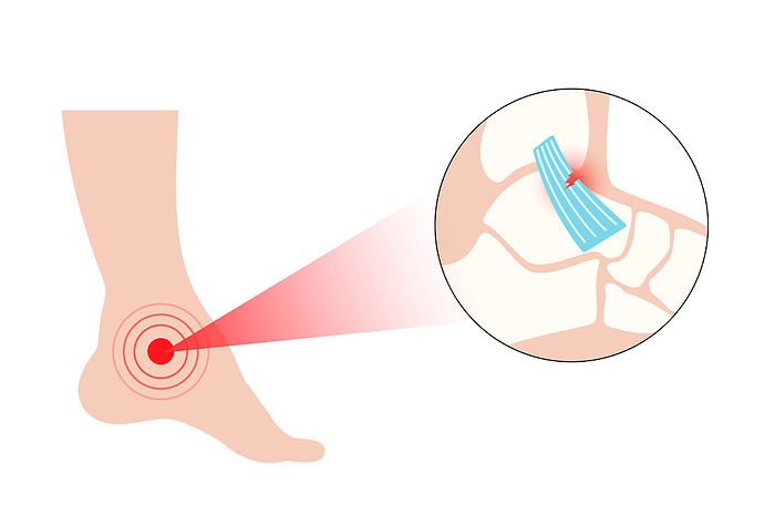 Ankle sprain injury, illustration Ankle sprain injury, illustration. Twisted feet, pain and swelling. Tearing, stretching or rupturing of ligaments., by PIKOVIT   SCIENCE PHOTO LIBRARY
