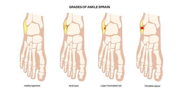 Ankle sprain injury, illustration Ankle sprain grades, illustration. Twisted feet, pain and swelling. Tearing, stretching or rupturing of ligaments., by PIKOVIT   SCIENCE PHOTO LIBRARY