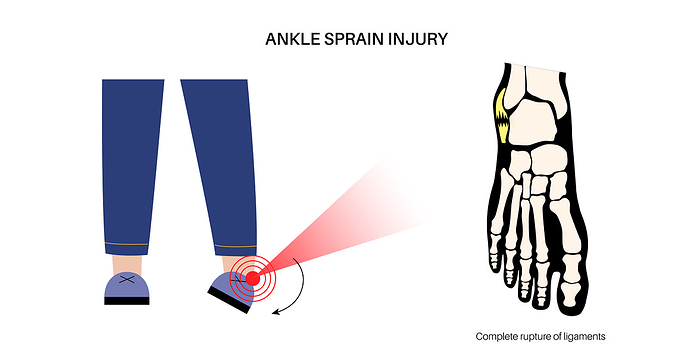 Ankle sprain injury, illustration Ankle sprain injury, illustration. Twisted feet, pain and swelling. Tearing, stretching or rupturing of ligaments., by PIKOVIT   SCIENCE PHOTO LIBRARY