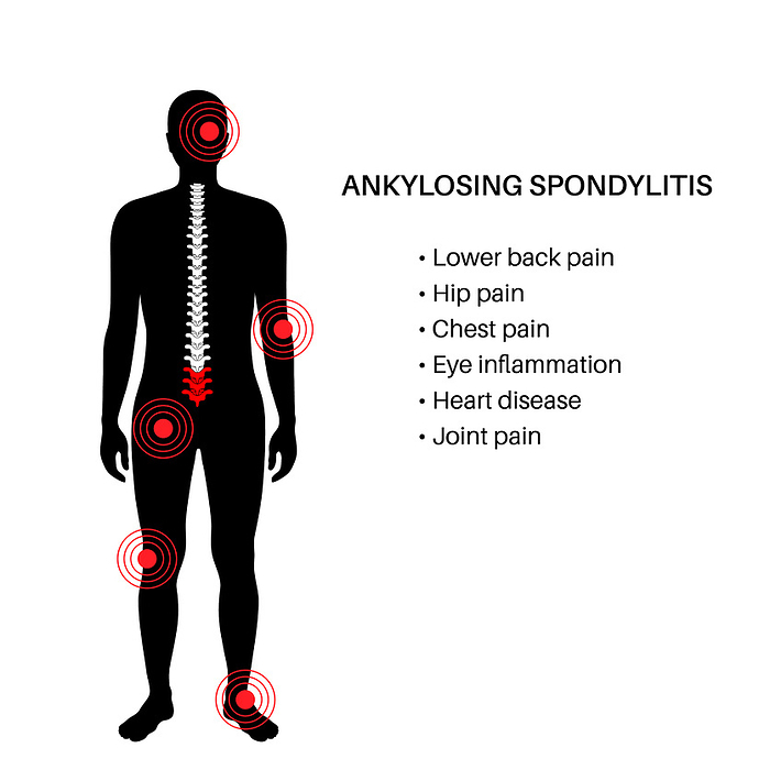 Ankylosing spondylitis, illustration Ankylosing spondylitis, illustration. Arthritis that causes inflammation in the joints and ligaments of the spine., by PIKOVIT   SCIENCE PHOTO LIBRARY