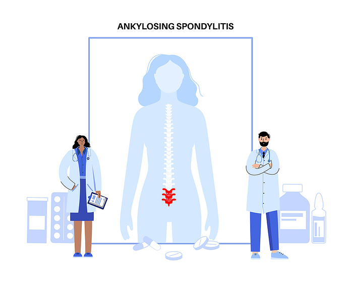 Ankylosing spondylitis, illustration Ankylosing spondylitis, illustration. Arthritis that causes inflammation in the joints and ligaments of the spine., by PIKOVIT   SCIENCE PHOTO LIBRARY