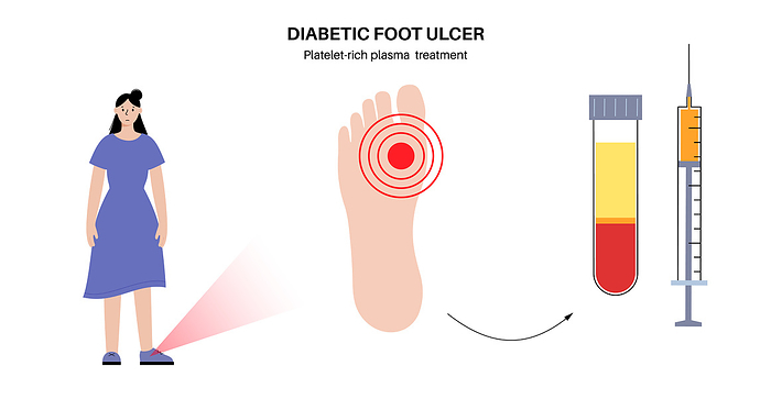 Diabetic foot syndrome treatment, illustration Diabetic foot syndrome treatment with platelet rich plasma, illustration. Platelet rich plasma  PRP  injection to treat an ulcer, open sore or wound on feet. Inflammation in skin and ligaments., by PIKOVIT   SCIENCE PHOTO LIBRARY