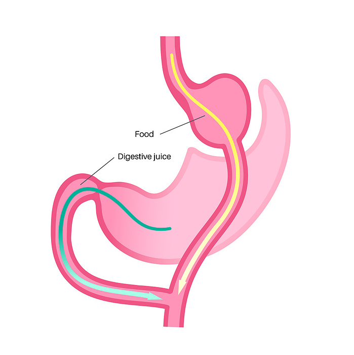 Gastric bypass surgery, illustration Gastric bypass gastroplasty operation, illustration. Roux en Y Gastric Bypass  RYGB  stomach surgery for weight loss., by PIKOVIT   SCIENCE PHOTO LIBRARY