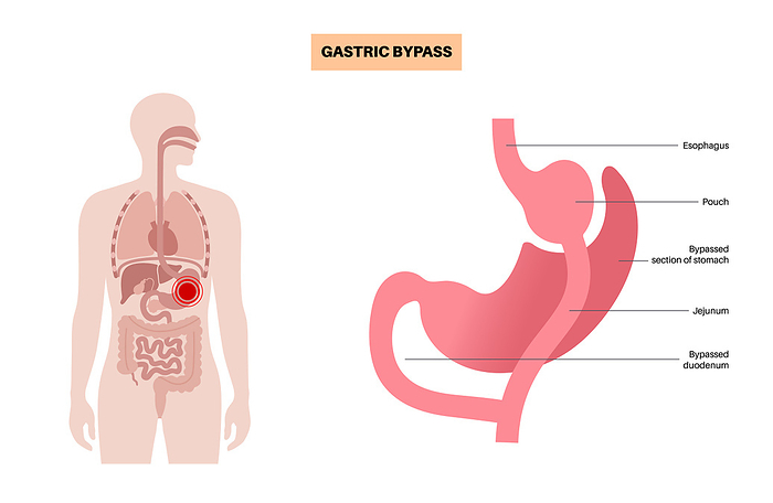 Gastric bypass surgery, illustration Gastric bypass gastroplasty operation, illustration. Roux en Y Gastric Bypass  RYGB  stomach surgery for weight loss., by PIKOVIT   SCIENCE PHOTO LIBRARY