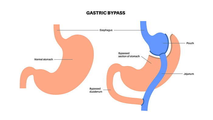 Gastric bypass surgery, illustration Gastric bypass gastroplasty stomach operation illustration. Human organs before and after surgery., by PIKOVIT   SCIENCE PHOTO LIBRARY