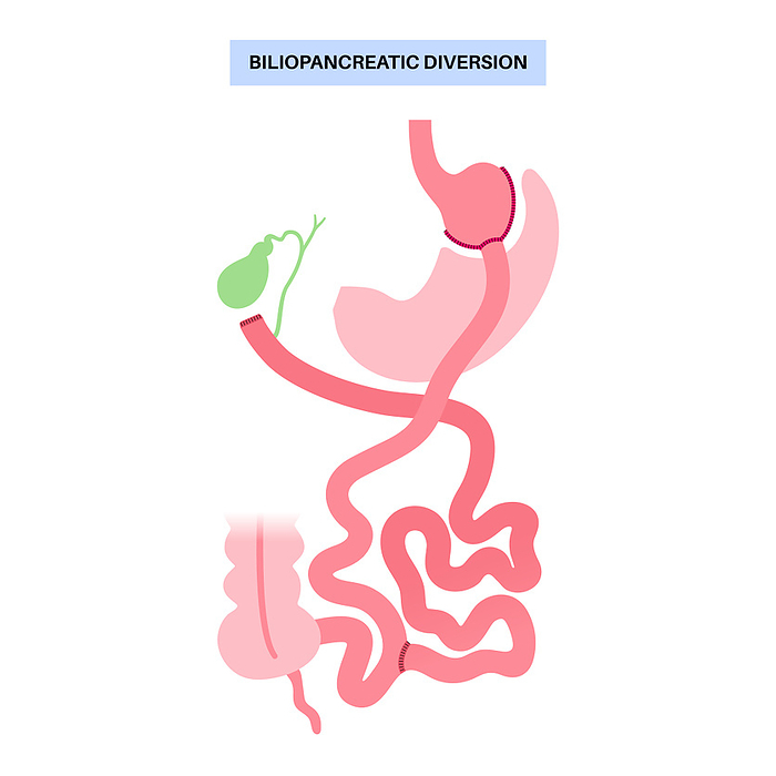 Biliopancreatic diversion procedure, illustration Biliopancreatic diversion  BPD  gastroplasty operation, illustration. Gastric procedure for weight loss., by PIKOVIT   SCIENCE PHOTO LIBRARY