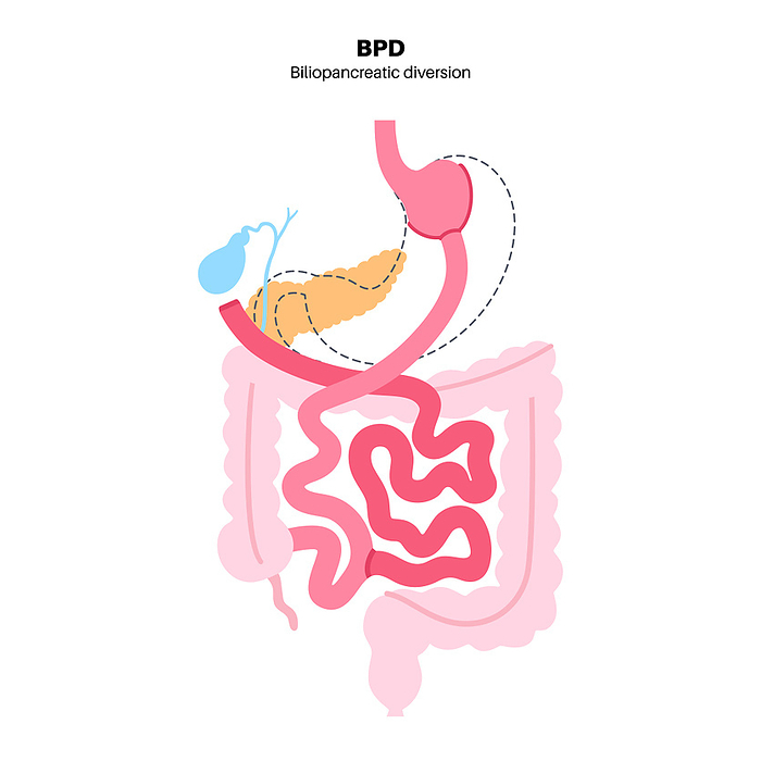 Biliopancreatic diversion procedure, illustration Biliopancreatic diversion  BPD  gastroplasty operation, illustration. Gastric procedure for weight loss., by PIKOVIT   SCIENCE PHOTO LIBRARY