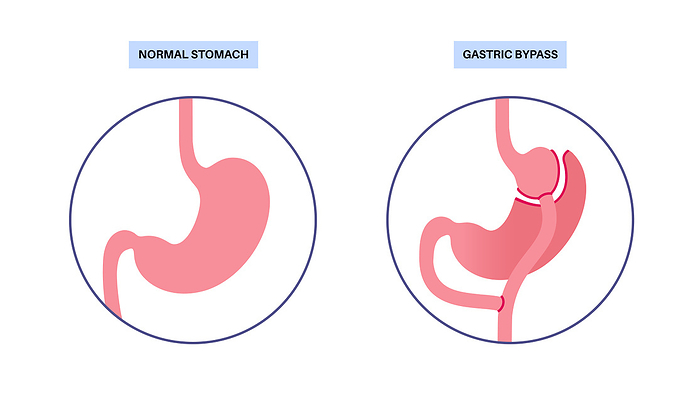 Gastric bypass surgery, illustration Gastric bypass gastroplasty stomach operation illustration. Human organs before and after surgery., by PIKOVIT   SCIENCE PHOTO LIBRARY