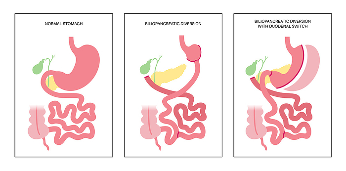 Biliopancreatic diversion procedure, illustration Biliopancreatic diversion  BPD  with duodenal switch, illustration. BPD stomach surgery, weight loss gastric procedure. Internal organs before and after operation., by PIKOVIT   SCIENCE PHOTO LIBRARY