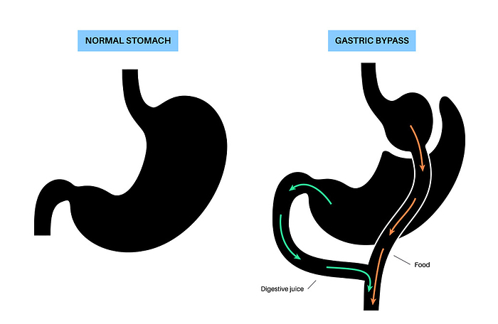 Gastric bypass surgery, illustration Gastric bypass gastroplasty stomach operation, illustration. Human organs before and after surgery., by PIKOVIT   SCIENCE PHOTO LIBRARY