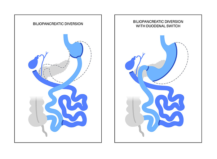 Biliopancreatic diversion procedure, illustration Biliopancreatic diversion  BPD  with duodenal switch, illustration. BPD stomach surgery, weight loss gastric procedure. Internal organs before and after operation., by PIKOVIT   SCIENCE PHOTO LIBRARY