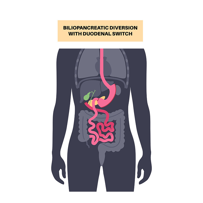 Biliopancreatic diversion procedure, illustration Biliopancreatic diversion  BPD  with duodenal switch, illustration. Gastric procedure for weight loss., by PIKOVIT   SCIENCE PHOTO LIBRARY