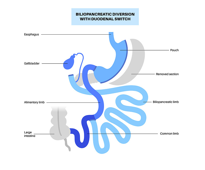 Biliopancreatic diversion procedure, illustration Biliopancreatic diversion  BPD  with duodenal switch, illustration. Gastric procedure for weight loss., by PIKOVIT   SCIENCE PHOTO LIBRARY