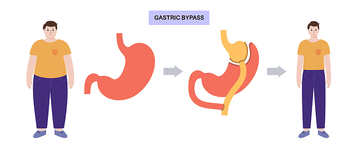 Gastric bypass surgery, illustration Gastric bypass gastroplasty operation, illustration. Male body before and after stomach surgery., by PIKOVIT   SCIENCE PHOTO LIBRARY