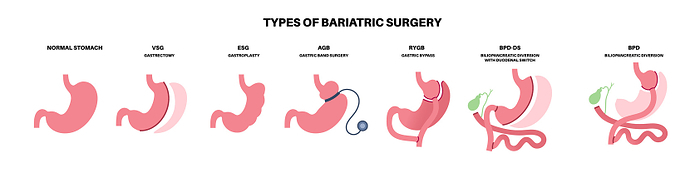 Types of bariatric surgery, illustration Types of bariatric surgery, illustration. Healthy stomach and internal organs after operation, weight loss gastric procedure. Abdomen laparoscopy concept., by PIKOVIT   SCIENCE PHOTO LIBRARY