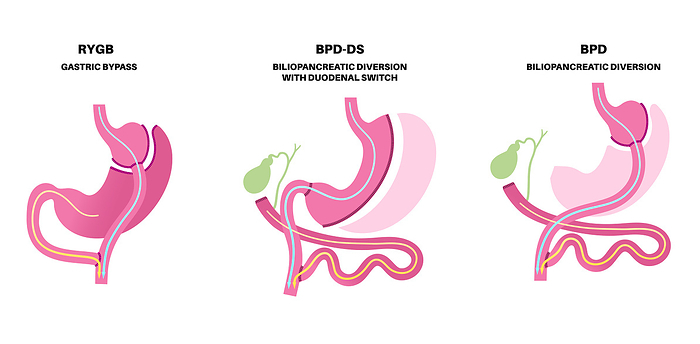 Types of bariatric surgery, illustration Biliopancreatic diversion  BPD  with duodenal switch and gastric bypass. Stomach surgery weight loss procedure. Internal organs before and after operation., by PIKOVIT   SCIENCE PHOTO LIBRARY