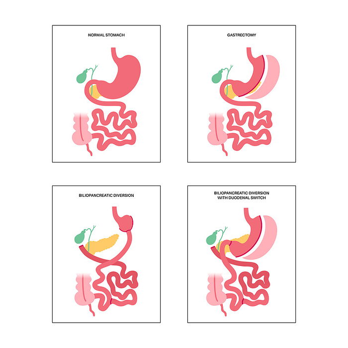 Types of bariatric surgery, illustration Types of bariatric surgery, illustration. Healthy stomach and internal organs after operation, weight loss gastric procedure. Abdomen laparoscopy concept., by PIKOVIT   SCIENCE PHOTO LIBRARY