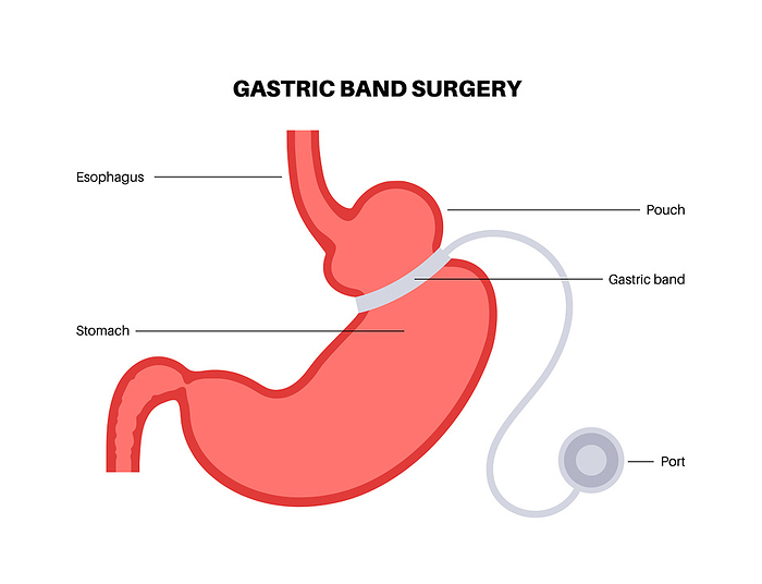 Gastric band medical procedure, illustration Gastric band medical procedure, illustration. Adjustable gastric banding  AGB  stomach surgery for weight loss., by PIKOVIT   SCIENCE PHOTO LIBRARY