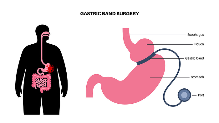 Gastric band medical procedure, illustration Gastric band medical procedure, illustration. Adjustable gastric banding  AGB  stomach surgery for weight loss., by PIKOVIT   SCIENCE PHOTO LIBRARY