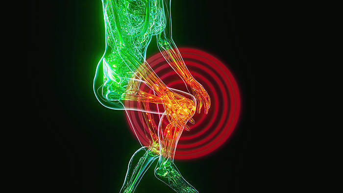Knee pain, conceptual illustration Knee pain, conceptual illustration., by JULIEN TROMEUR SCIENCE PHOTO LIBRARY