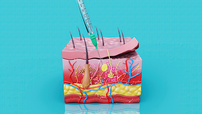 Injection, illustration Illustration of an injection into the dermis of the skin., by JULIEN TROMEUR SCIENCE PHOTO LIBRARY