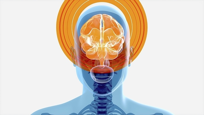 Headache, conceptual illustration Headache, conceptual illustration., by JULIEN TROMEUR SCIENCE PHOTO LIBRARY