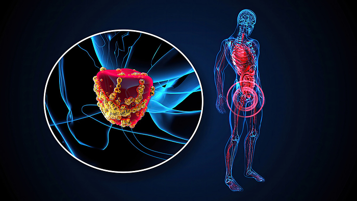 Prostate cancer, conceptual illustration Prostate cancer, conceptual illustration., by JULIEN TROMEUR SCIENCE PHOTO LIBRARY