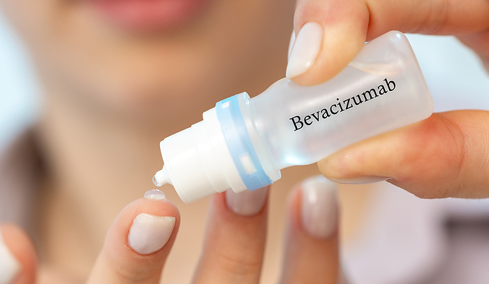 Bevacizumab medical drops, conceptual image Bevacizumab medical drops, conceptual image. An anti angiogenic drug used off label to treat certain eye conditions, such as macular edema and diabetic retinopathy., by Wladimir Bulgar SCIENCE PHOTO LIBRARY