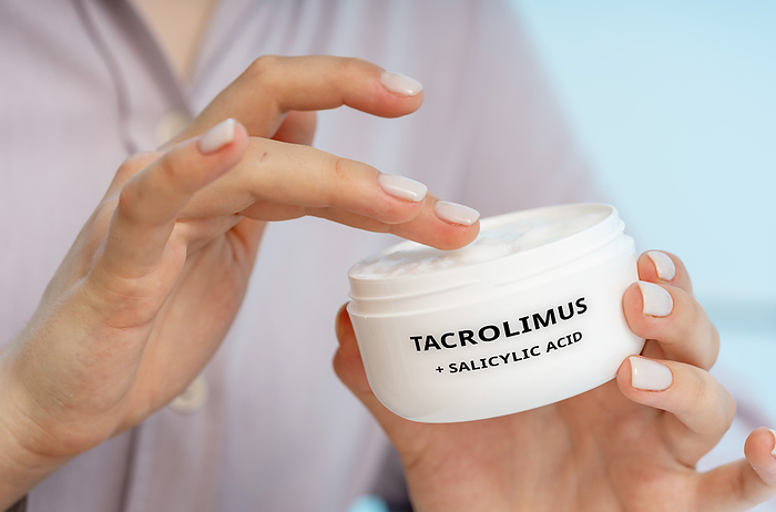 Tacrolimus and salicylic acid medical cream, conceptual image Tacrolimus and salicylic acid medical cream, conceptual image. A combination cream used to treat psoriasis and other inflammatory skin conditions by reducing inflammation and scaling., by Wladimir Bulgar SCIENCE PHOTO LIBRARY
