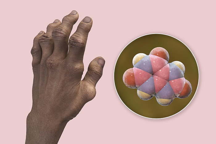 Gout afflicted hands with deformities, illustration Illustration of gout afflicted hands with deformities and close up view of uric acid molecule, revealing the destructive impact of chronic uric acid crystal deposition., by KATERYNA KON SCIENCE PHOTO LIBRARY