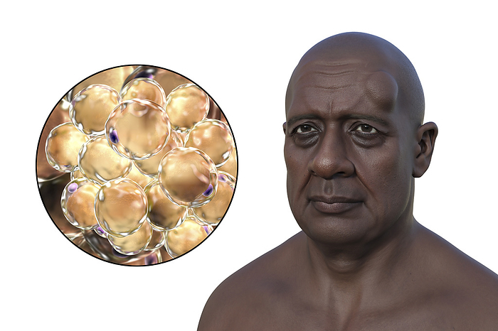 Lipoma on a man s forehead, illustration Illustration of lipoma on a man s forehead, and close up view of adipocytes, the fat cells constituting the lipoma growth., by KATERYNA KON SCIENCE PHOTO LIBRARY