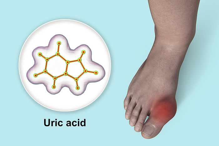 Gout afflicted foot, illustration Illustration of gout afflicted foot and close up view of uric acid molecule, revealing the destructive impact of chronic uric acid crystal deposition., by KATERYNA KON SCIENCE PHOTO LIBRARY