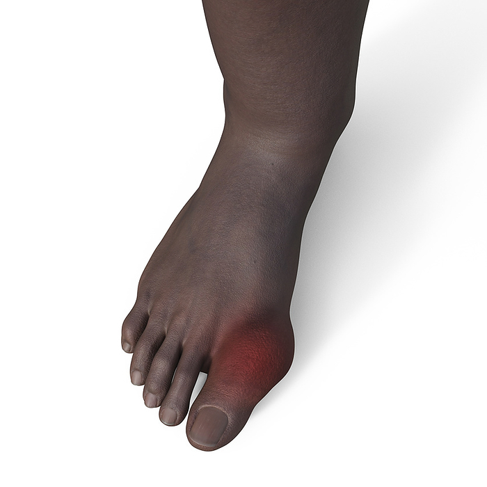 Gout afflicted foot, illustration Illustration of a gout afflicted foot, showcasing inflammation and deformity in the toe joint., by KATERYNA KON SCIENCE PHOTO LIBRARY