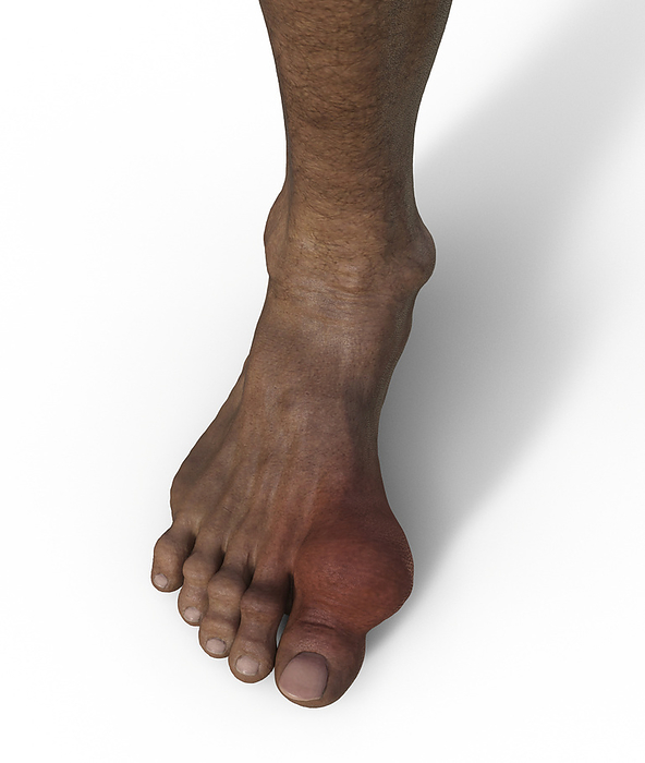 Gout afflicted foot, illustration Illustration of a gout afflicted foot, showcasing inflammation and deformity in the toe joint., by KATERYNA KON SCIENCE PHOTO LIBRARY