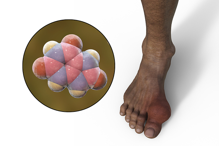 Gout afflicted foot, illustration Illustration of gout afflicted foot and close up view of uric acid molecule, revealing the destructive impact of chronic uric acid crystal deposition., by KATERYNA KON SCIENCE PHOTO LIBRARY