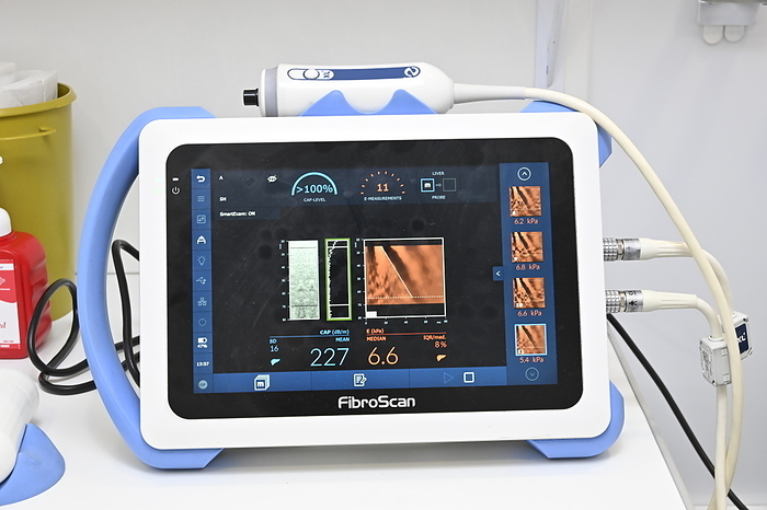 Fibroscan diagnostic device FibroScan is a non invasive medical test that helps to evaluate the liver s health. The test measures the stiffness of the liver, which can indicate the presence of liver fibrosis  scarring  and cirrhosis. The FibroScan diagnostic device uses a technique called transient elastography, where a special probe is placed on the skin s surface, typically on the right side of the abdomen. The probe sends sound waves into the liver, and the speed at which these sound waves travel through the liver tissue is measured. This measurement provides information about the liver s stiffness. Medical professionals use this test to diagnose and monitor liver diseases like hepatitis C, cirrhosis, and fatty liver disease., by DR P. MARAZZI SCIENCE PHOTO LIBRARY
