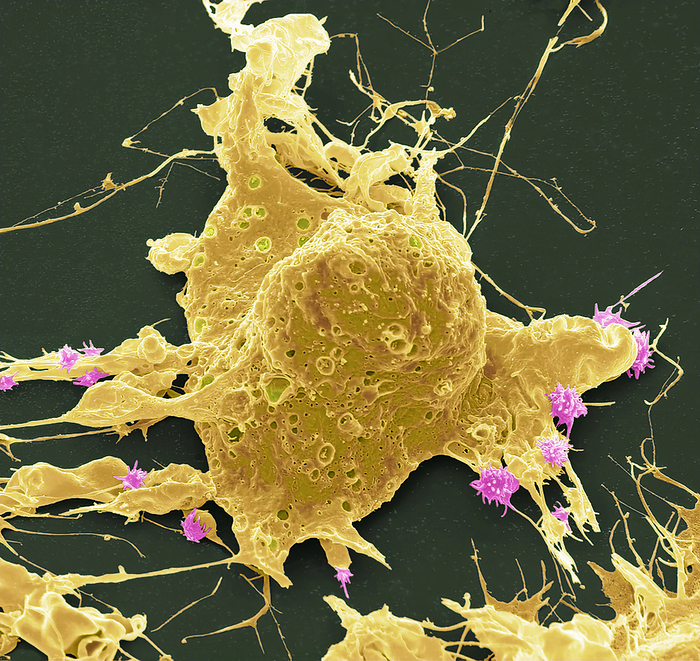 Chemotherapy induced cell death, SEM Chemotherapy induced cell death. Coloured scanning electron micrograph  SEM  of a cultured cancer cell  HeLa  treated with doxorubicin to cause necrosis. Doxorubicin is a type of chemotherapy drug called an anthracycline. Cell death can be programmed as in apoptosis or unregulated as in necrosis. Necrosis can be a dose or time related effect of this drug in cultured cancer cells. This method of death can trigger inflammation and harm healthy cells, which is why oncolgists strive to tip the balance towards apoptosis. Morphologically at SEM level, necrotic cells characteristically display ruptured plasma membrane, and cell lysis. The numerous visible holes are characteristic of early necrosis. Magnification: x4000 when printed at 10 centimetres wide. Specimen courtesy of Greg Towers, UCL. For a set of images showing the treated cells see C058 5931 to C058 5967., by STEVE GSCHMEISSNER SCIENCE PHOTO LIBRARY
