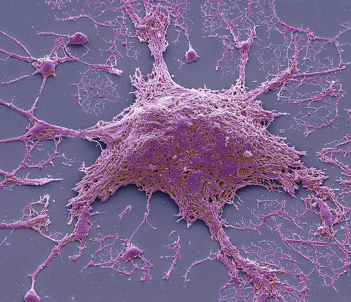 Chemotherapy induced cell death, SEM Chemotherapy induced cell death. Coloured scanning electron micrograph  SEM  of a cultured cancer cell  HeLa  treated with doxorubicin to cause necrosis. Doxorubicin is a type of chemotherapy drug called an anthracycline. Cell death can be programmed as in apoptosis or unregulated as in necrosis. Necrosis can be a dose or time related effect of this drug in cultured cancer cells. This method of death can trigger inflammation and harm healthy cells, which is why oncolgists strive to tip the balance towards apoptosis. Morphologically at SEM level, necrotic cells characteristically display ruptured plasma membrane, and cell lysis. The numerous visible holes are characteristic of early necrosis. Magnification: x2500 when printed at 10 centimetres wide. Specimen courtesy of Greg Towers, UCL. For a set of images showing the treated cells see C058 5931 to C058 5967., by STEVE GSCHMEISSNER SCIENCE PHOTO LIBRARY
