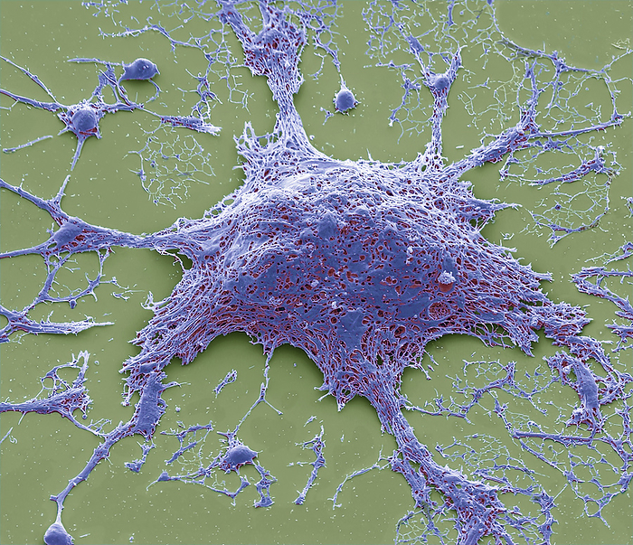 Chemotherapy induced cell death, SEM Chemotherapy induced cell death. Coloured scanning electron micrograph  SEM  of a cultured cancer cell  HeLa  treated with doxorubicin to cause necrosis. Doxorubicin is a type of chemotherapy drug called an anthracycline. Cell death can be programmed as in apoptosis or unregulated as in necrosis. Necrosis can be a dose or time related effect of this drug in cultured cancer cells. This method of death can trigger inflammation and harm healthy cells, which is why oncolgists strive to tip the balance towards apoptosis. Morphologically at SEM level, necrotic cells characteristically display ruptured plasma membrane, and cell lysis. The numerous visible holes are characteristic of early necrosis. Magnification: x2500 when printed at 10 centimetres wide. Specimen courtesy of Greg Towers, UCL. For a set of images showing the treated cells see C058 5931 to C058 5967., by STEVE GSCHMEISSNER SCIENCE PHOTO LIBRARY