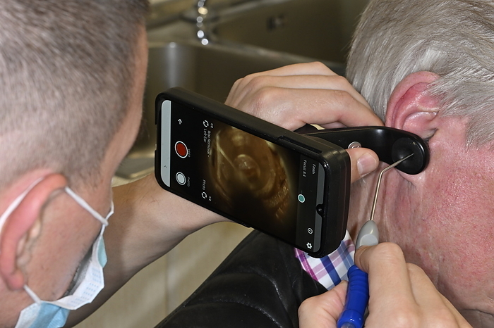 Removal of foreign body from ear canal Removal of a foreign body from ear canal procedure., by DR P. MARAZZI SCIENCE PHOTO LIBRARY