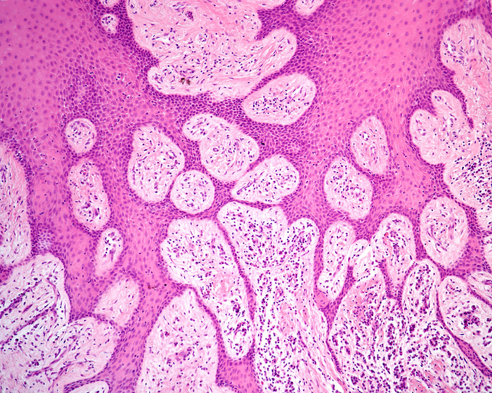 Human gingiva epithelium, light micrograph Light micrograph of human gingiva  gums . It is lined by a non keratinised stratified squamous epithelium with long and complex rete ridges. The connective tissue under the epithelium shows chronic inflammatory infiltrates  gingivitis ., by JOSE CALVO   SCIENCE PHOTO LIBRARY