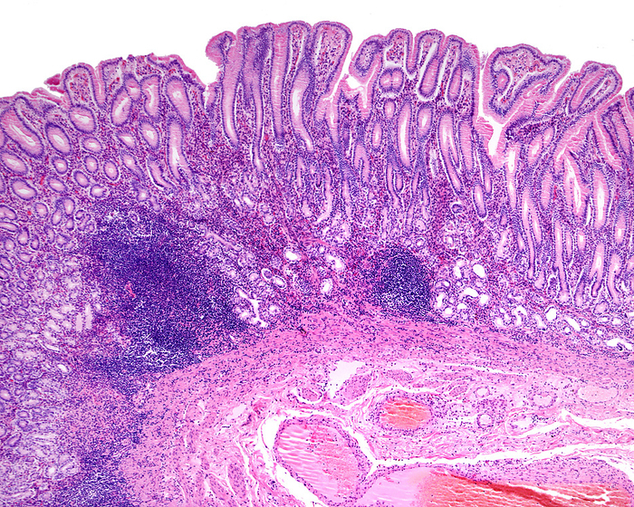 Human gastric mucosa, light micrograph Light micrograph if the mucosa of the stomach in the region of the pyloric antrum showing its typical features: great depth of the gastric crypts and presence of pyloric glands. There are chronic inflammatory infiltrates and the presence of lymphoid follicles in the lamina propria suggesting an infection by Helicobacter pylori bacteria, a common cause of gastritis., by JOSE CALVO   SCIENCE PHOTO LIBRARY