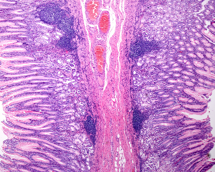 Human gastric mucosa, light micrograph Light micrograph of the fold of the gastric wall showing the mucosa of the stomach in the region of the pyloric antrum with its typical features: great depth of the gastric crypts and presence of pyloric glands. There are chronic inflammatory infiltrates and the presence of lymphoid follicles in the lamina propria suggesting an infection by Helicobacter pylori bacteria, a common cause of gastritis., by JOSE CALVO   SCIENCE PHOTO LIBRARY