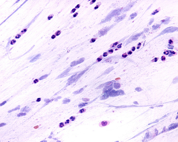 Sputum smear in acute bronchitis, light micrograph Sputum smear showing abundant neutrophil leucocytes, light micrograph. This suggests an acute inflammation of the lung airways  acute bronchitis ., by JOSE CALVO   SCIENCE PHOTO LIBRARY