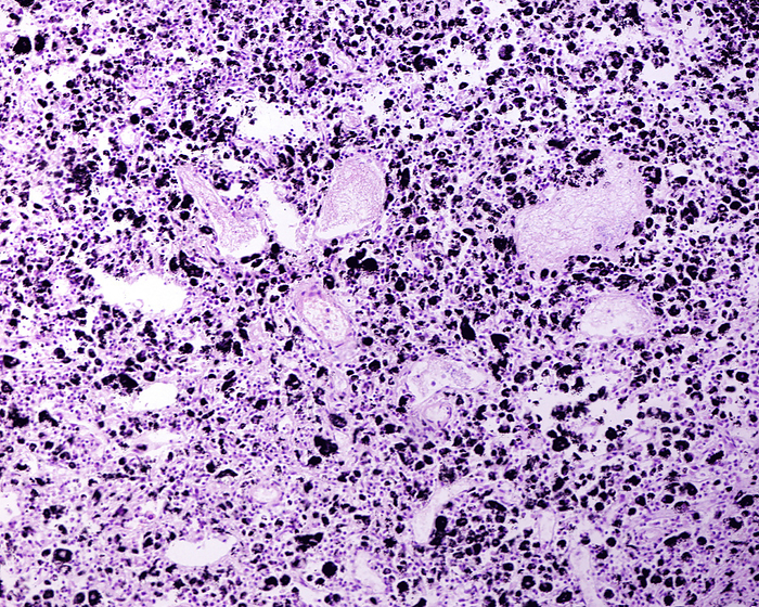 Lymph node anthracosis, light micrograph Light micrograph of a human lymph node located near the hilus of an anthracotic lung. Numerous anthracotic macrophages  black points  are dispersed inside the lymph node. Haematoxylin eosin stain., by JOSE CALVO   SCIENCE PHOTO LIBRARY