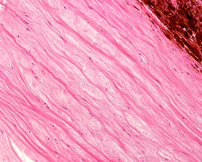 Sclera and lamina fusca, light micrograph Light micrograph showing the limit between the sclera, white of the eye, and lamina fusca  top right . The sclera is a dense connective tissue made of mainly type I collagen fibres, oriented in different directions. The lamina fusca shows many pigmented cells., by JOSE CALVO   SCIENCE PHOTO LIBRARY