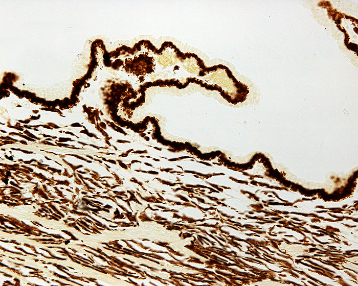 Ciliary body pigment, light micrograph Ciliary body pigment, light micrograph. Unstained ciliary body  pars plicata  showing the location of pigment in the folds, or ciliary processes  inner pigmented epithelium , and the ciliary body stroma., by JOSE CALVO   SCIENCE PHOTO LIBRARY